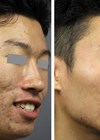 Before and after pictures of the patient treated with ablative fractional nanosecond Nd:YAG. 