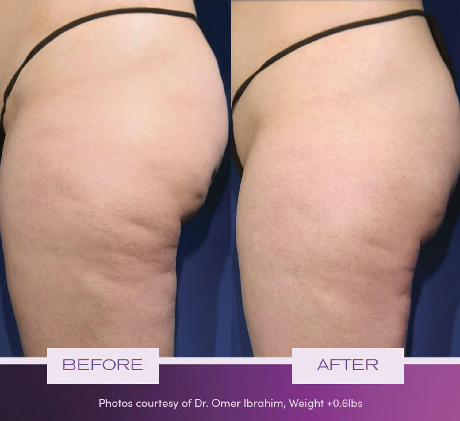 Cellulite therapy in 2022 – new treatment options making grades for the new  year