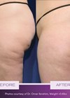 Photos showing RESONIC cellulite treatment.