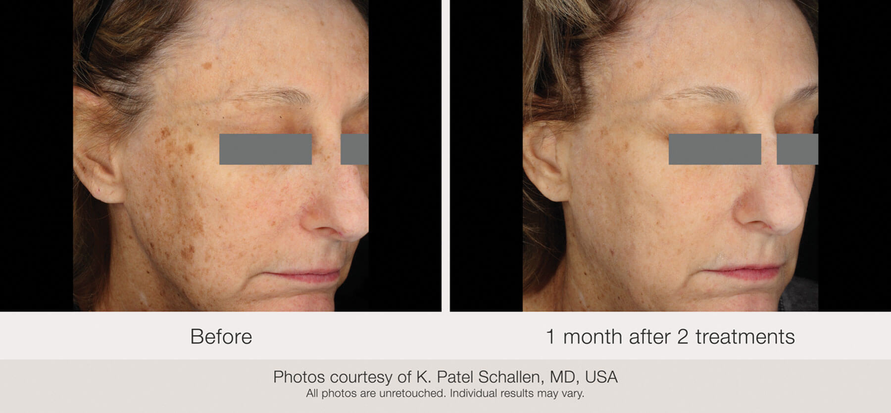 Photos showing before and one month after two treatments.