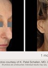 Photos showing before and one month after two treatments. 