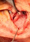 Photo showing flap delivery through the defect and secured anteriorly. 
