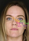 Image of patient demonstrating the locations of the nasojugal groove (NJG), the tear trough (TT) groove, the palpebromalar groove (PMG) and the mid-cheek groove (MCG).