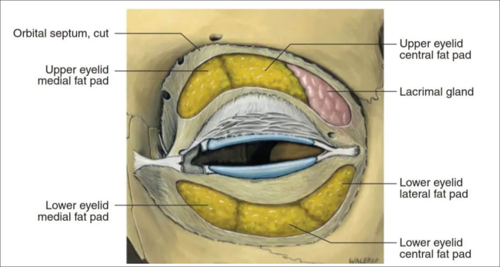 Illustration showing An 8mm soft tissue thickening at the lacrimal fossa of the right orbit involving the orbital and palpebral portions of the lacrimal gland. 