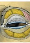 Illustration showing An 8mm soft tissue thickening at the lacrimal fossa of the right orbit involving the orbital and palpebral portions of the lacrimal gland. 