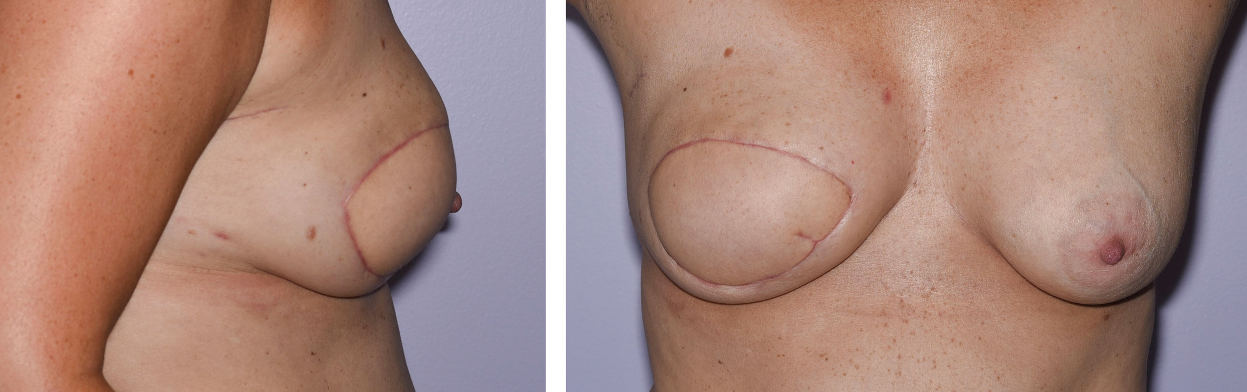 Photos showing mastectomy and immediate free flap reconstruction - result at six weeks post operation.  