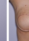 Photos showing mastectomy and immediate free flap reconstruction - result at six weeks post operation. 