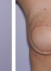 Photos showing mastectomy and immediate free flap reconstruction - result at six weeks post operation.  