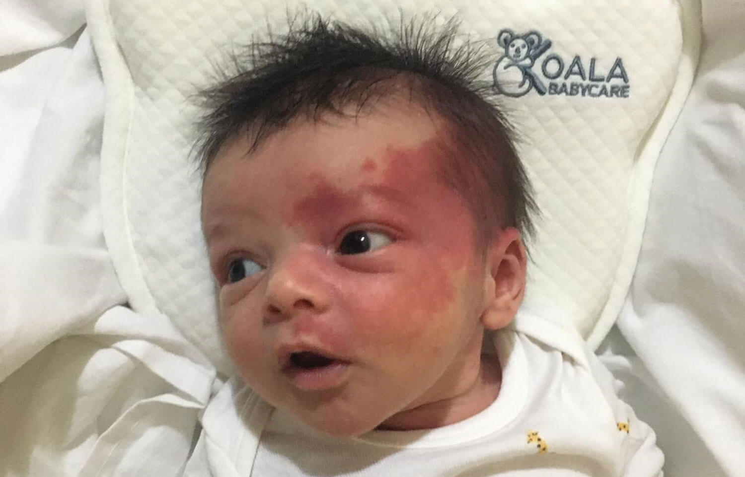 Photo showing port wine stain in infant - before treatment. 