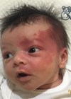 Photo showing port wine stain in infant - before treatment.