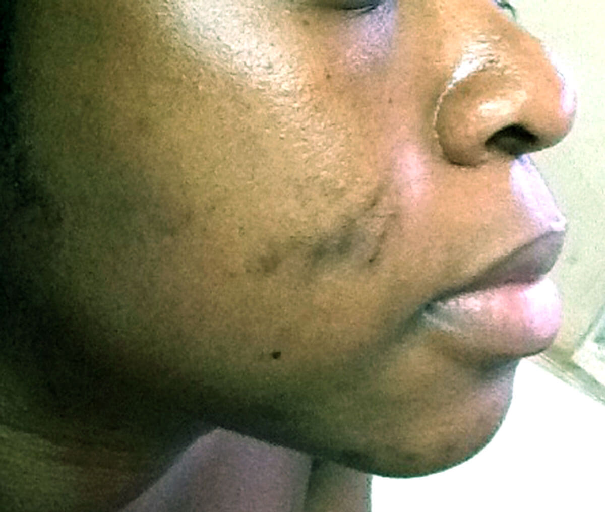 Combination therapy for PIH in skin of colour article before treatment photo.