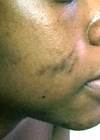 Combination therapy for PIH in skin of colour article before treatment photo.