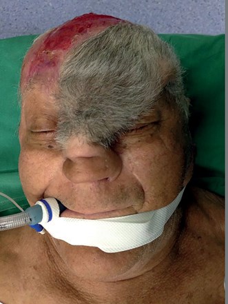 limpiador Una vez más Componer Converse scalping flap for nasal reconstruction procedures | The PMFA  Journal