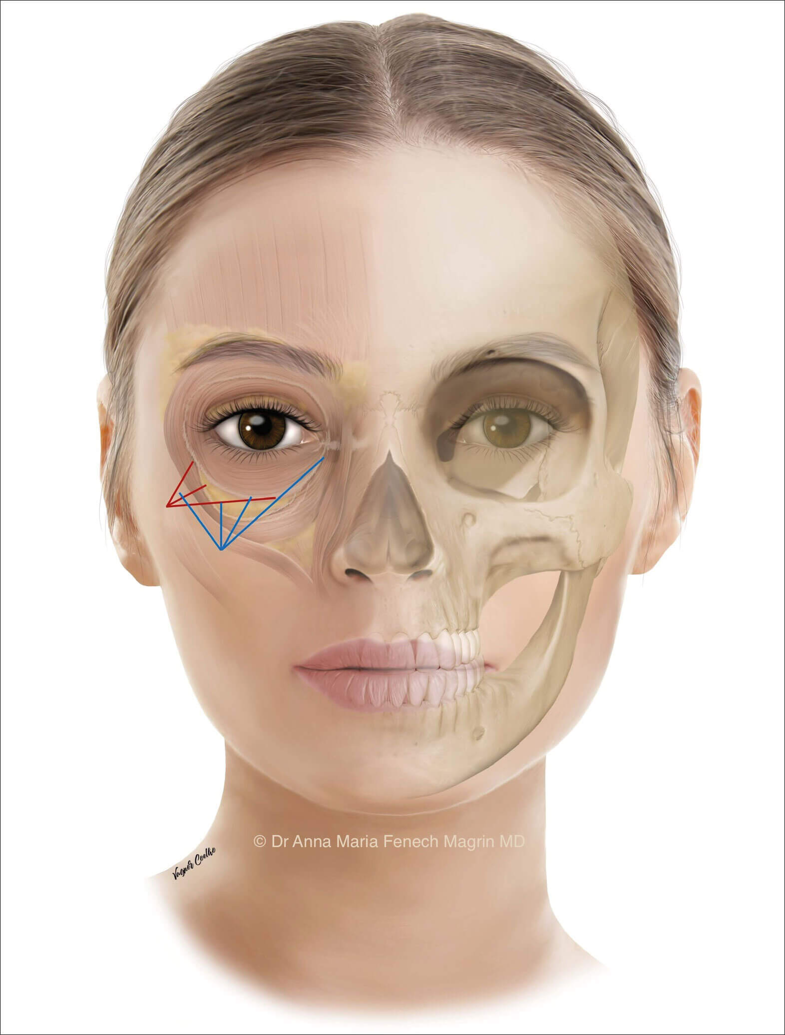 Illustration of face showing inferior / medial entry point and cannula injection path / lateral entry point and cannula injection path. 