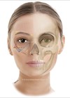 Illustration of face showing inferior / medial entry point and cannula injection path / lateral entry point and cannula injection path.