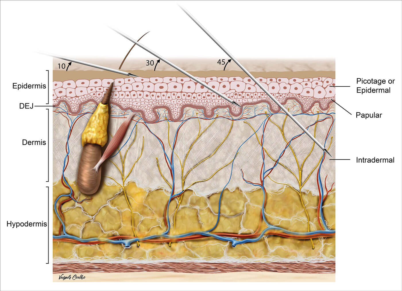 Schematic representation of skin layers and injection techniques. 