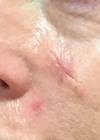 Photo - after excision of the tumour, basal and lateral margins were still affected.