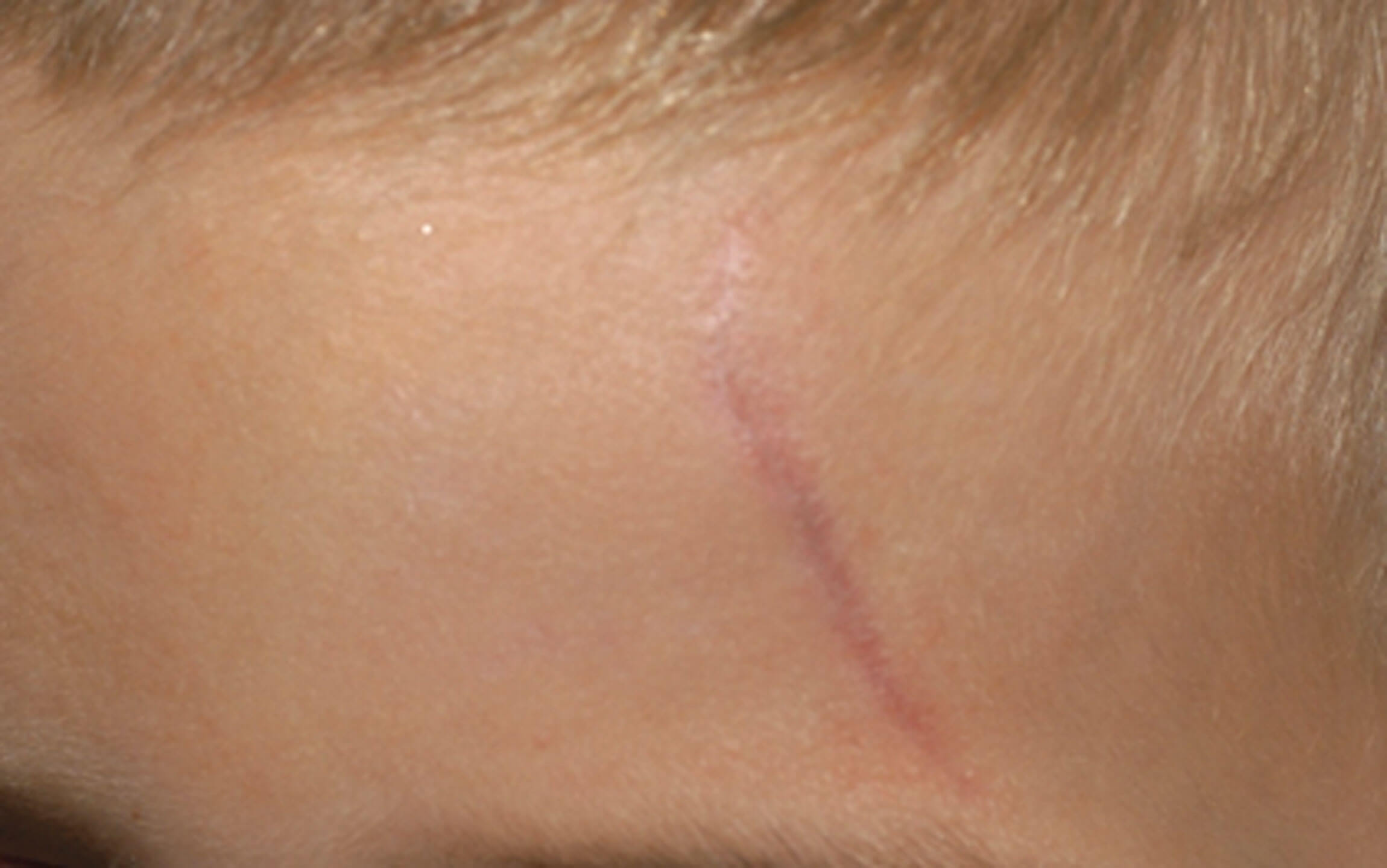 Photo of forehead scar before treatment.