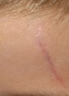 Photo of forehead scar before treatment.