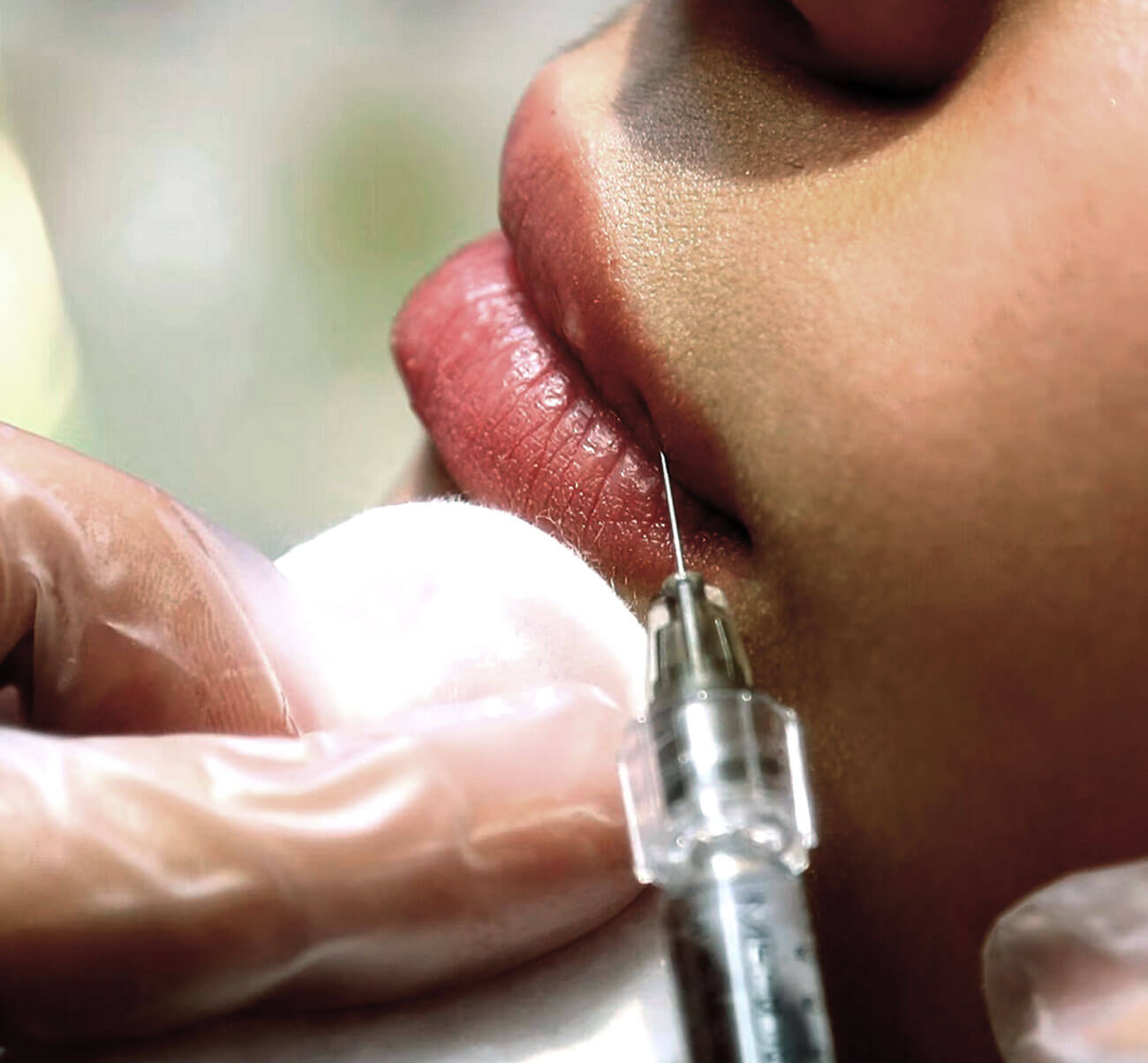 Photo of lip injection. 