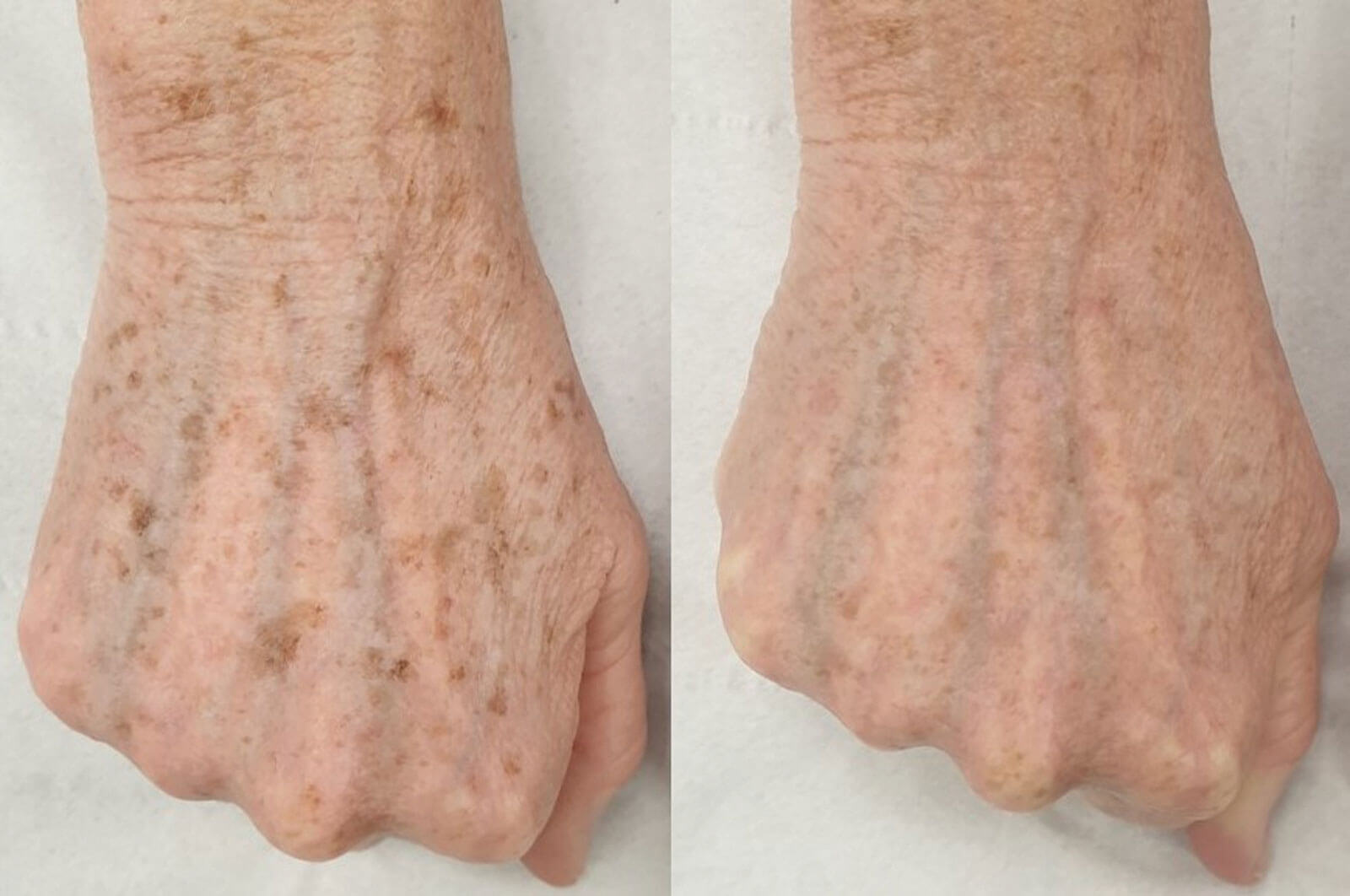 Images showing photodamage with lentigos on the back of the hand treated with the combination of Frax 1940 and topical lightening serums and creams.