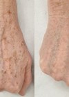 Images showing photodamage with lentigos on the back of the hand treated with the combination of Frax 1940 and topical lightening serums and creams.
