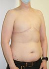 Photo showing bilateral mastectomy with no nipple placement in a non-binary patient.