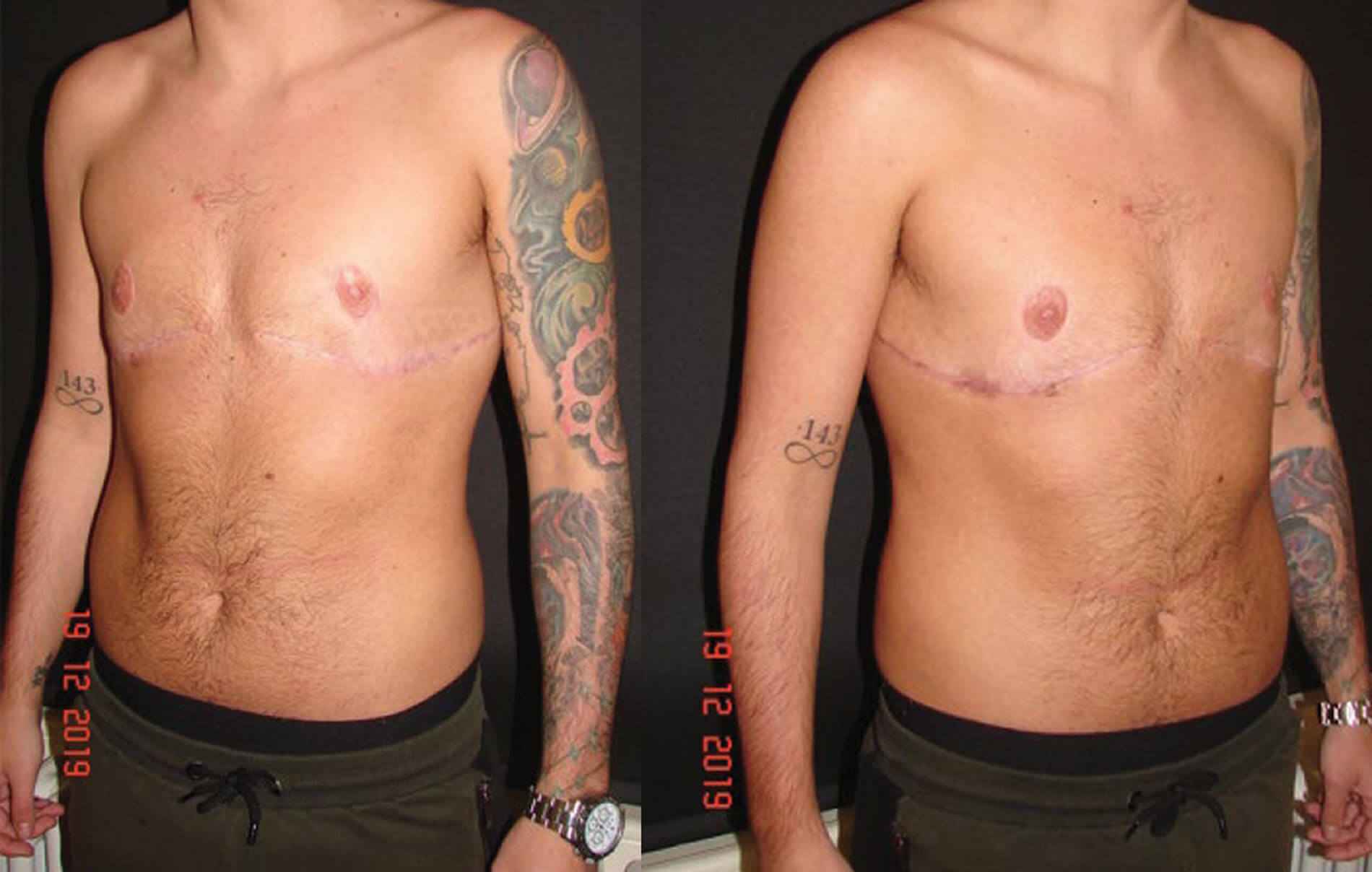 Images showing bilateral mastectomy with free nipple grafting. 