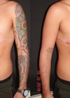 Images showing bilateral mastectomy with free nipple grafting.