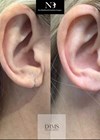 Images showing earlobe splits and subsequent repair.