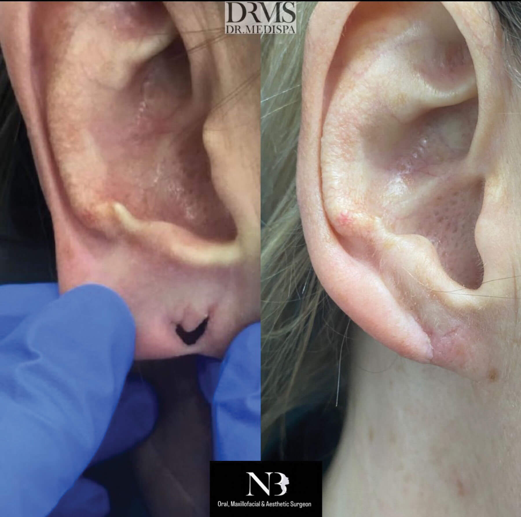 Split' earlobe repair