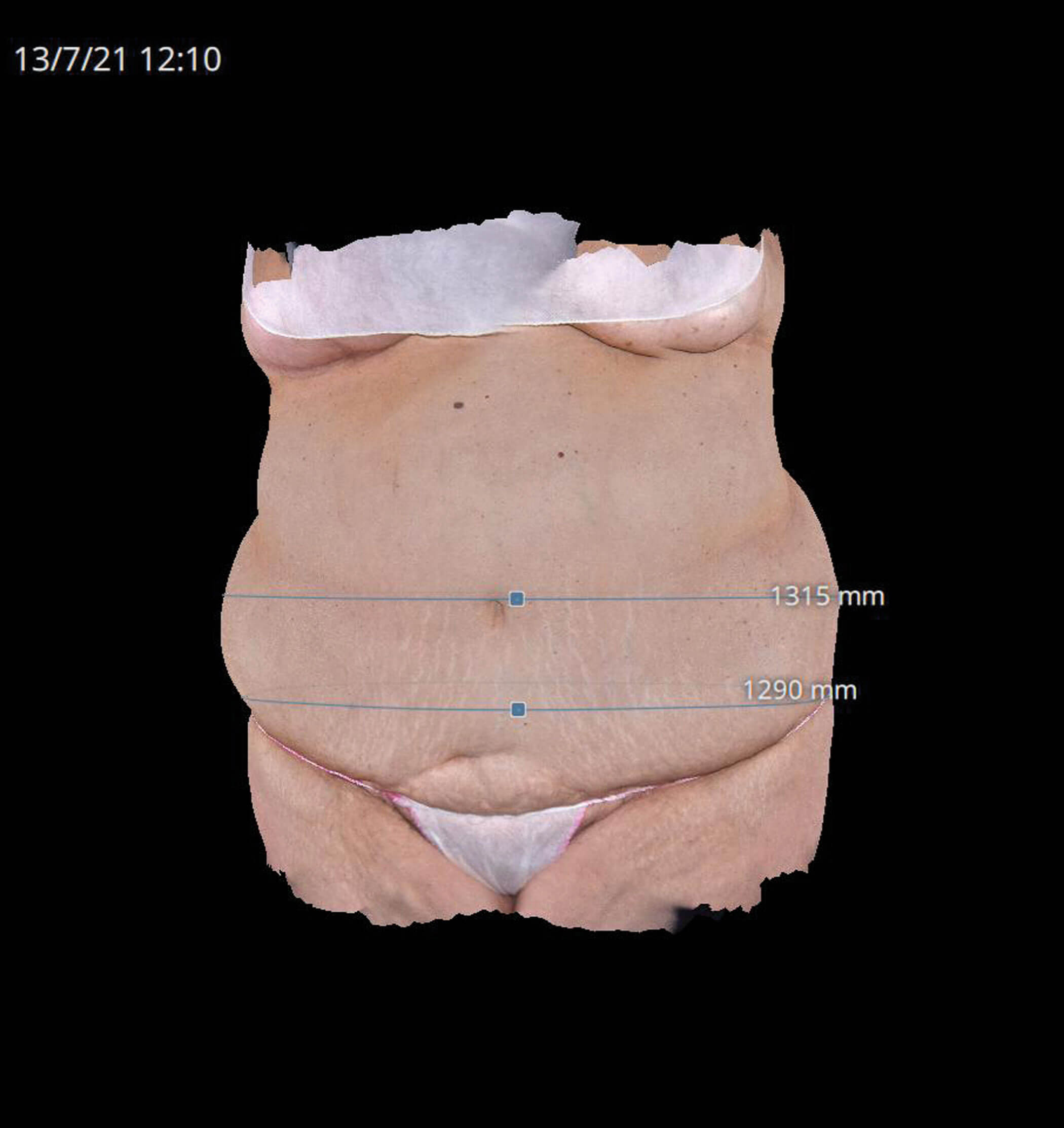 Photo illustrating body contouring areas.