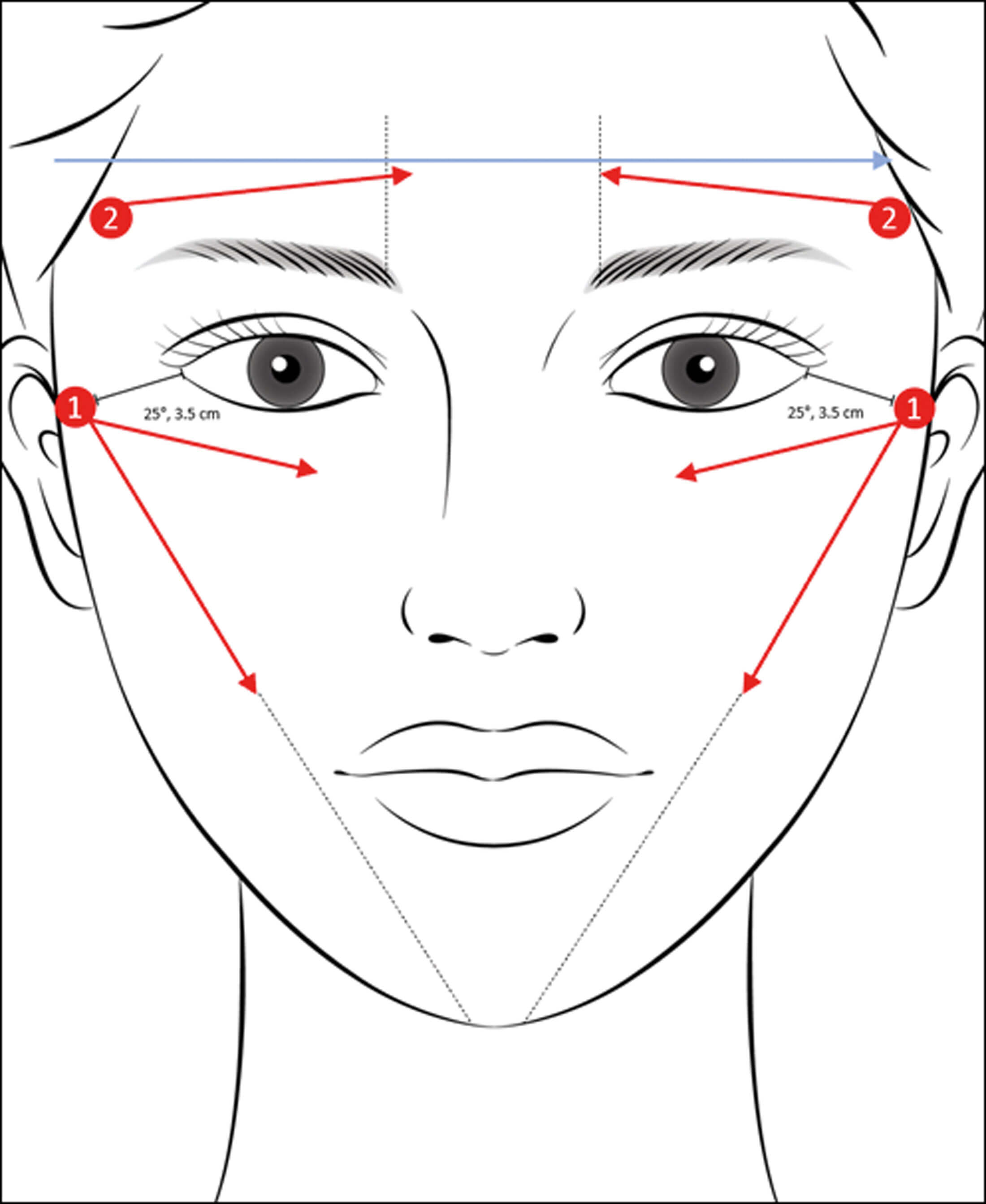 Illustration of facial areas for treatments of liquid polycaprolactone.