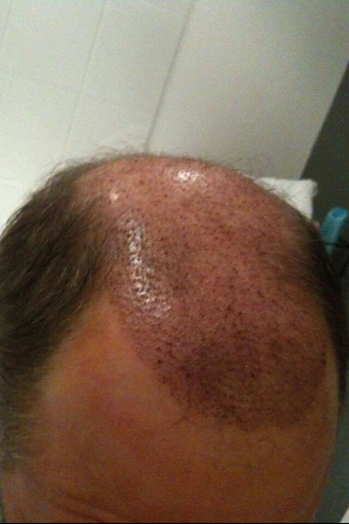 A Guide To Hair Transplantation The Pmfa Journal