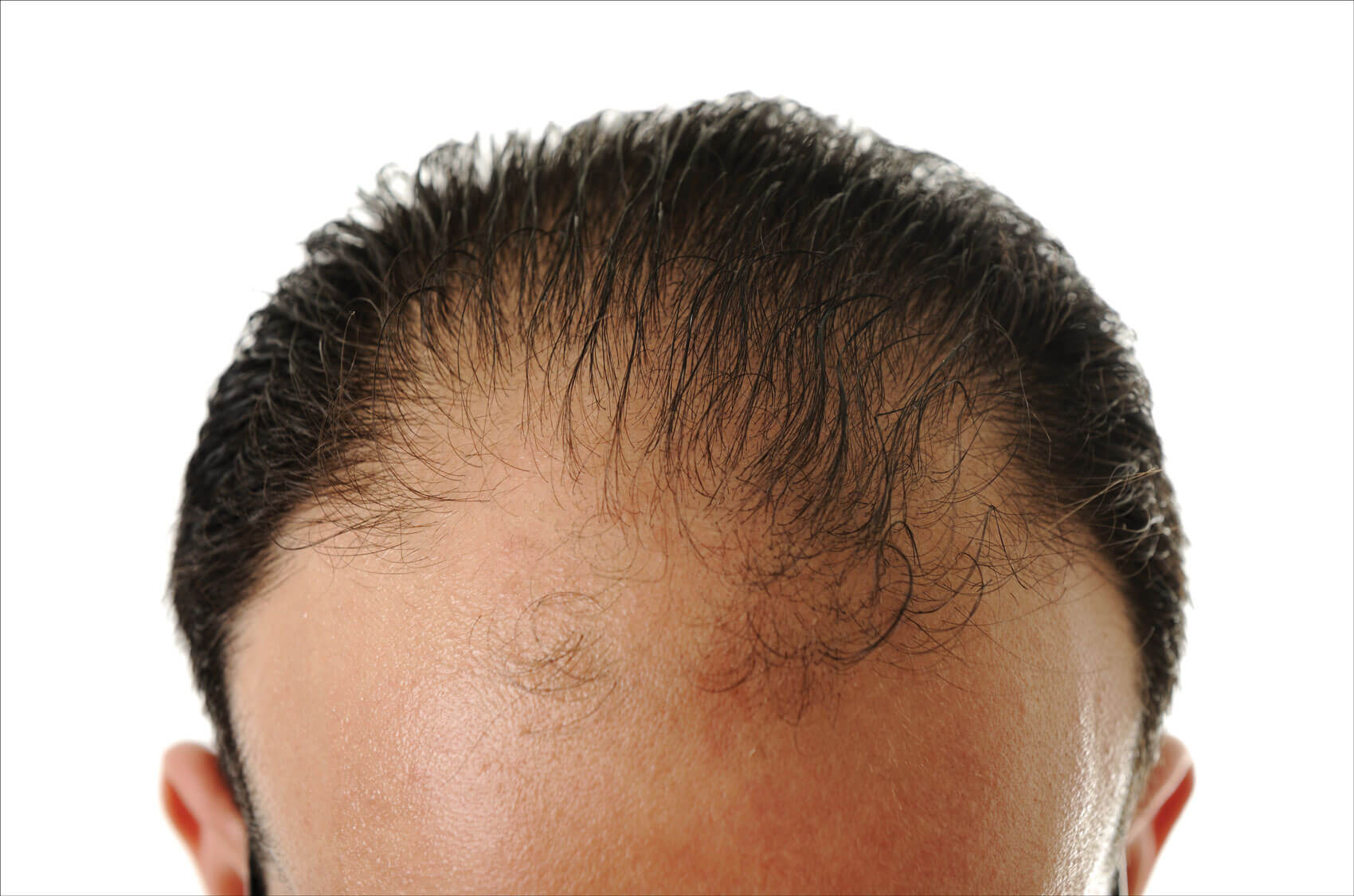 Photo depicting male hair loss. 