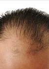 Photo depicting male hair loss.