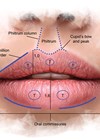 Illustration showing surface anatomy of ideal lips and perioral area.