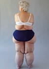 Lipoedema article image.