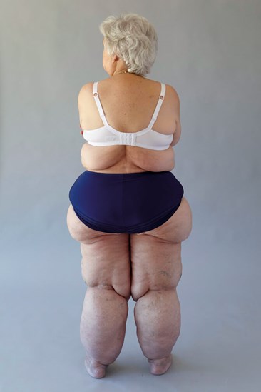 Can you lose weight with Lipedema? - Lipedema and Me