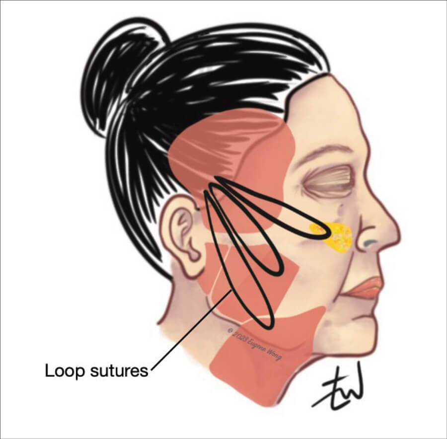 Illustration showing minimal access cranial suspension (MACS) facelift with loop sutures. 