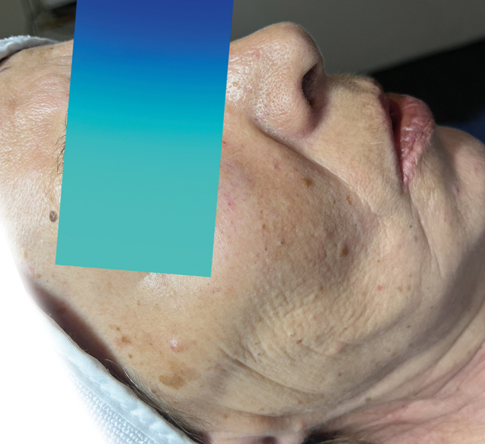 Biphasic medical peeling combined with microneedling before photo.