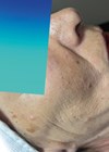Biphasic medical peeling combined with microneedling before photo.
