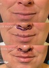 Image shows the patient before and after lip lift.