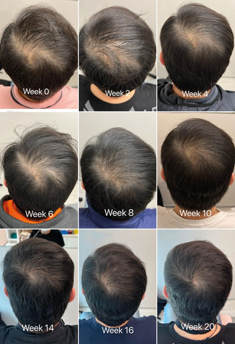 Photos showing treatment of androgenetic alopecia using red deer UCL-MSC exosomal proteins.