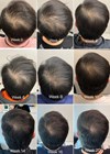 Photos showing treatment of androgenetic alopecia using red deer UCL-MSC exosomal proteins.