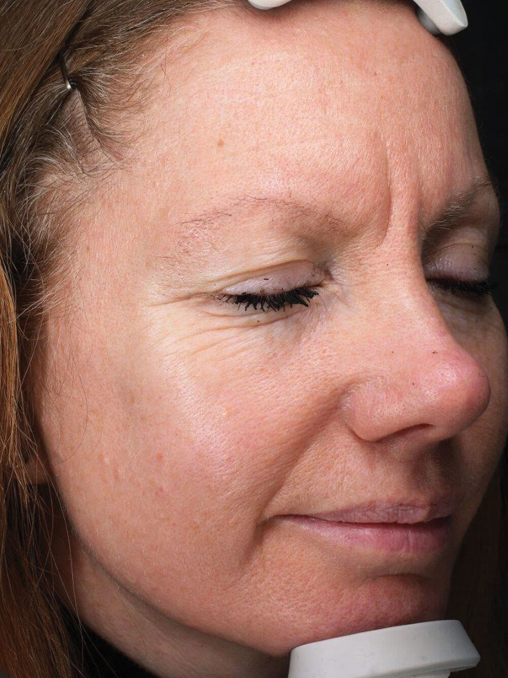 Baseline Visia image prior to commencing skin regime taken on.