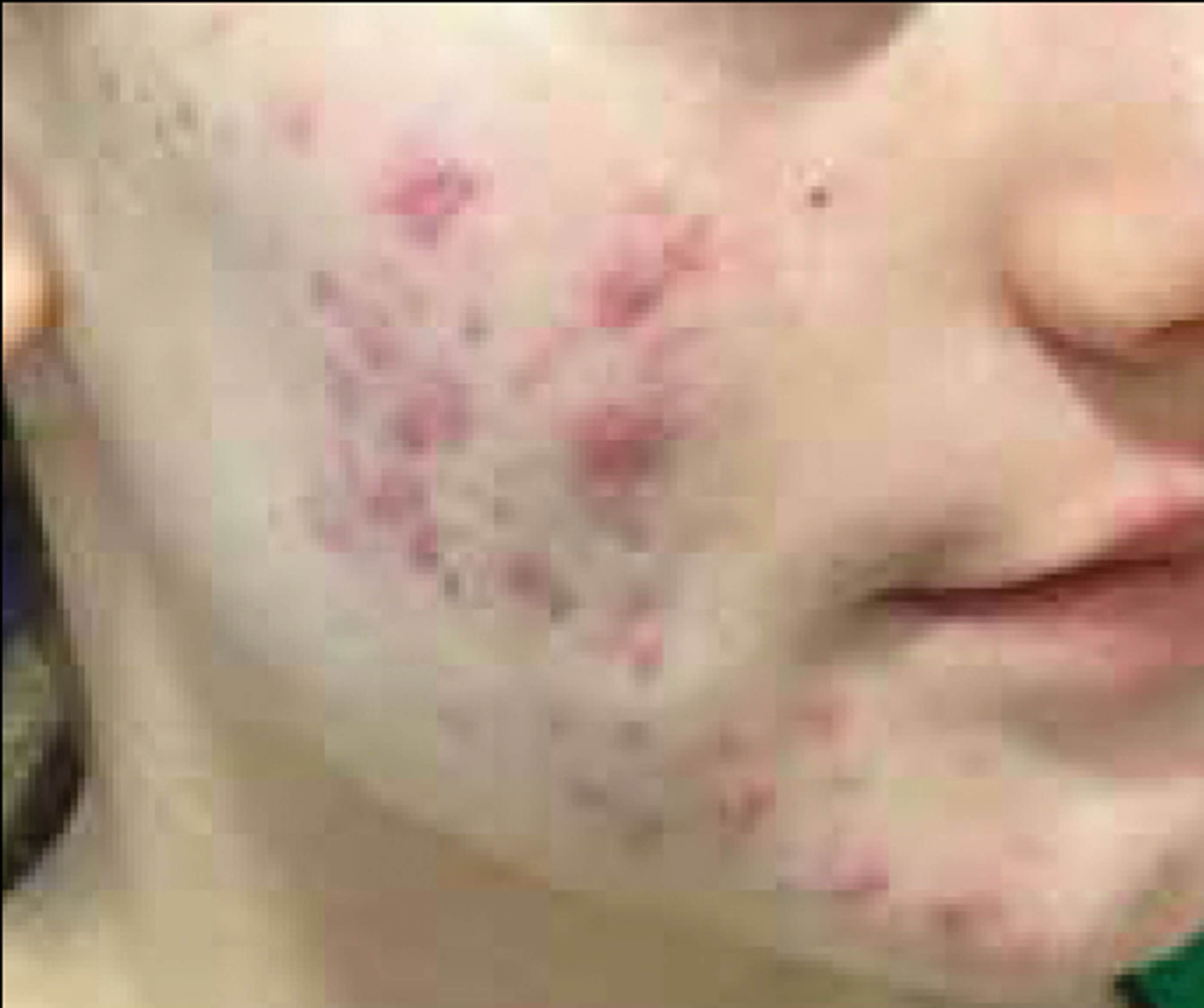 Photos showing before acne treatment. 