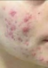 Photos showing before acne treatment.