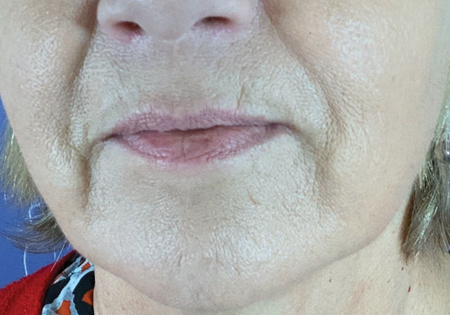 Diala Haykal article image showing patient after three treatments.