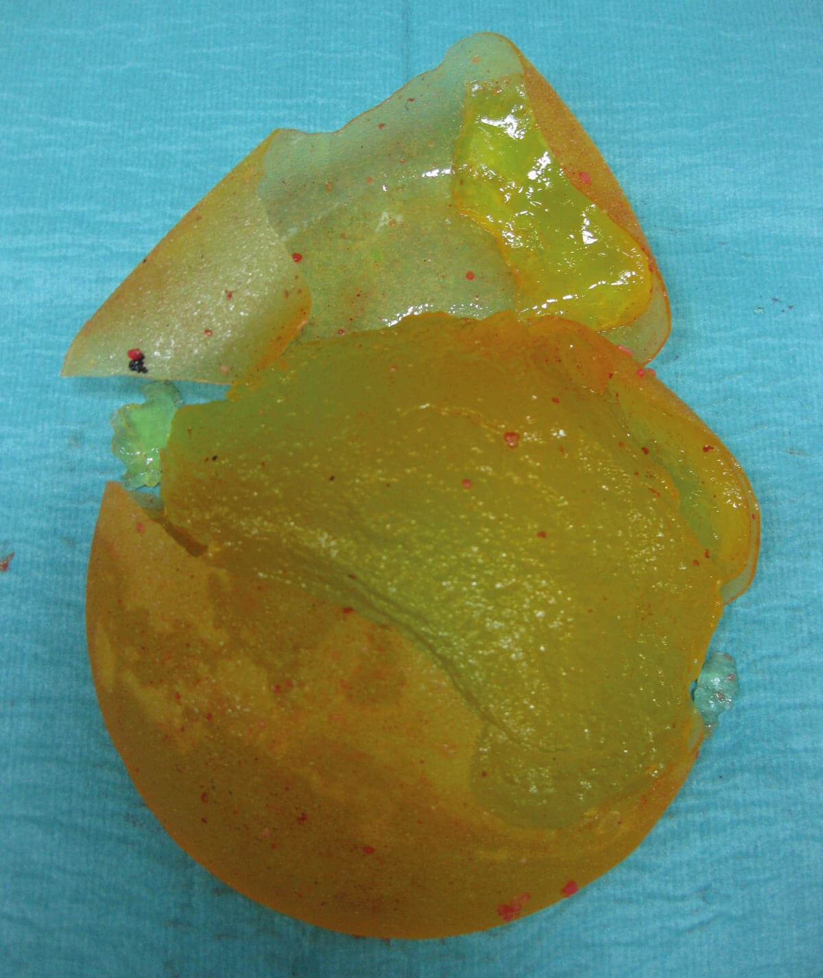 Image showing a ruptured silicone breast implant.